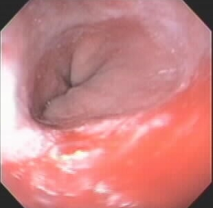 ENDOSCOPIC IMAGE FOLLOWING MYOTOMY