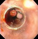 BANDING ESOPHAGEAL VARICES