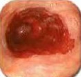 BARRETT'S ESOPHAGUS