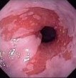 BARRETT'S ESOPHAGUS
