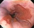 BARRETT'S ESOPHAGUS