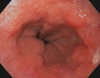 BARRETT'S MUCOSA - MALIGNANCY