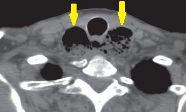 BILATERAL KILLIAN JAMIESON DIVERTICULA