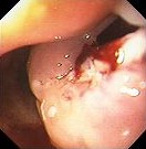 BRONCHIAL-ESOPHAGEAL FISTULA