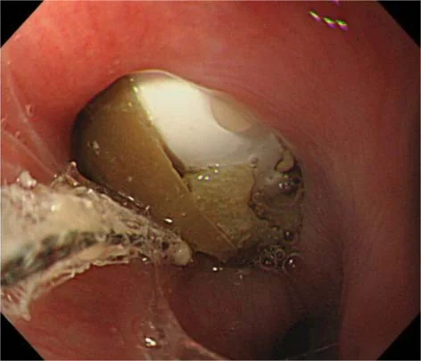 CAPSULE RETENSION IN ZENKER'S DIVERTICULUM
