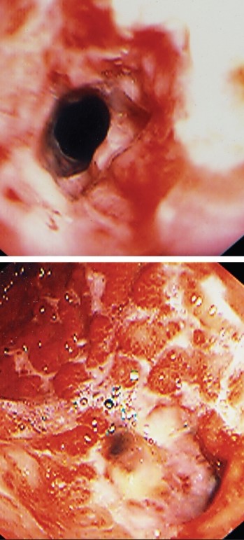 CAUSTIC ALKALI INGESTION