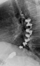 CORKSCREW ESOPHAGUS