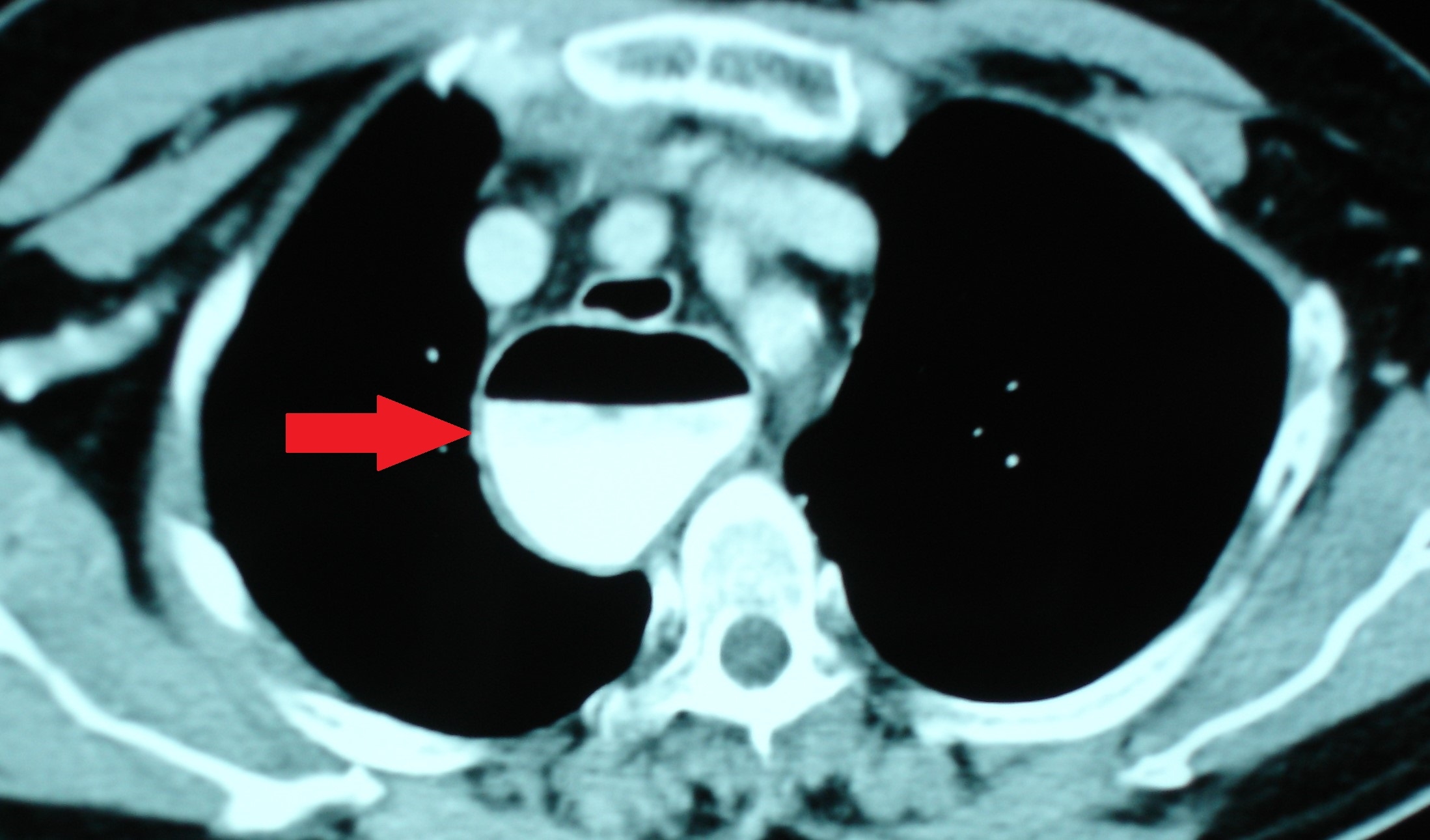 ESOPHAGEAL ACHALASIA - MEGA ESOPHAGUS