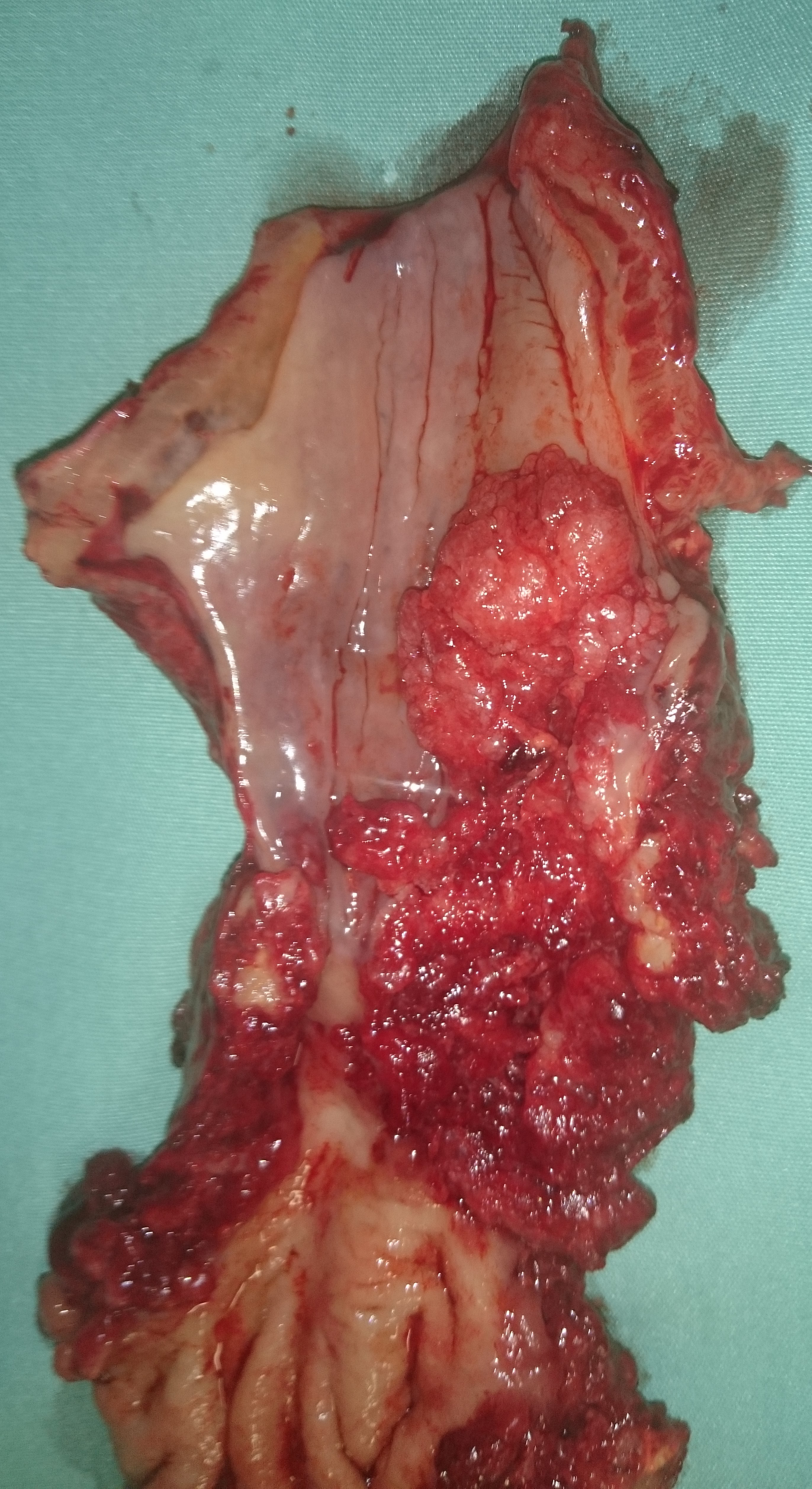 ESOPHAGEAL CARCINOMA