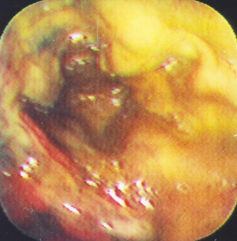 ESOPHAGEAL BURNS
