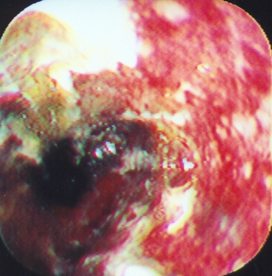 ESOPHAGEAL BURNS