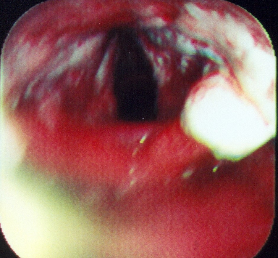 ESOPHAGEAL BURNS