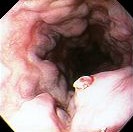 ESOPHAGEAL BLEEDING VESSEL