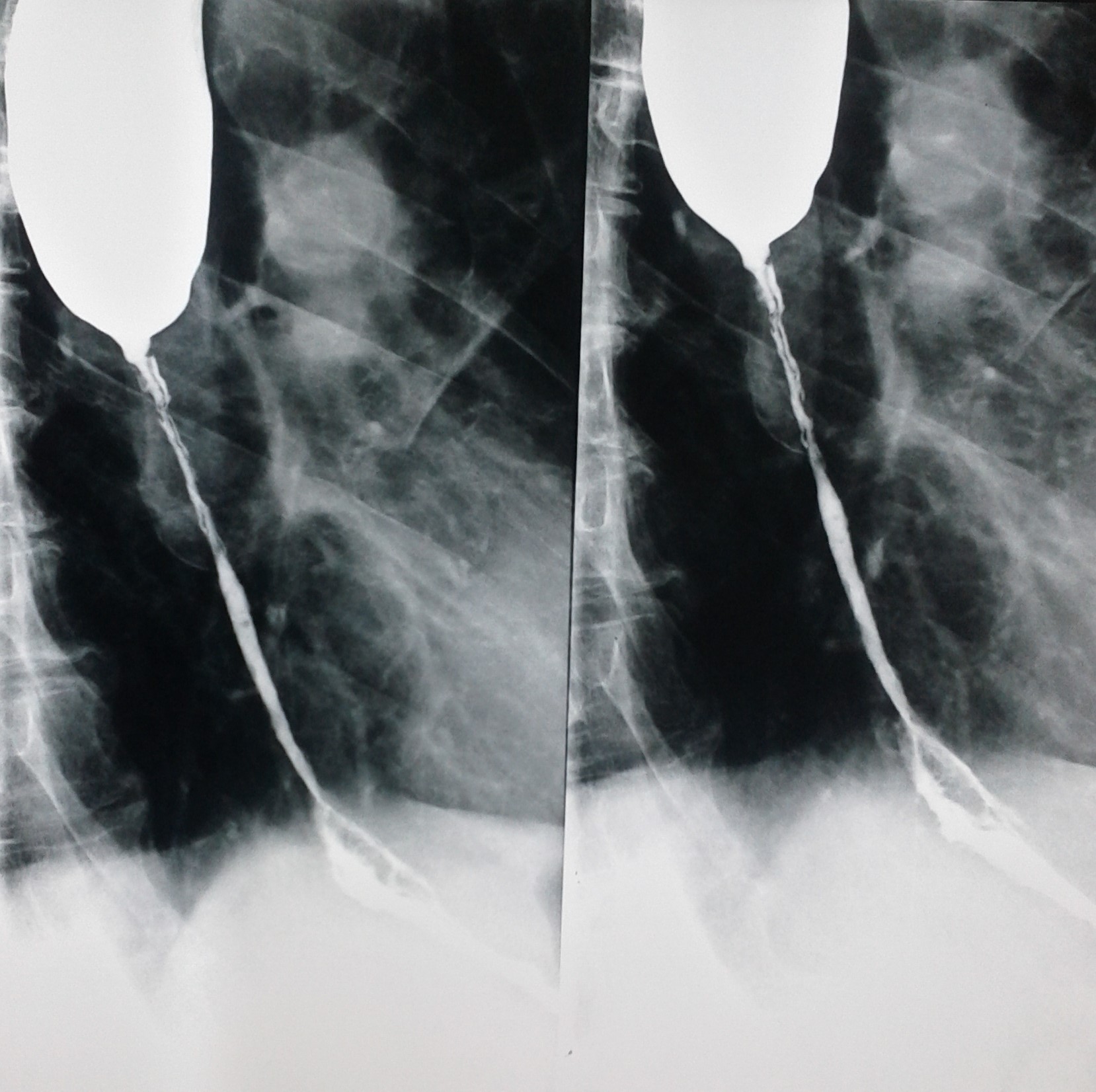 ESOPHAGEAL BURNS - STRICTURES