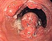 ESOPHAGEAL CARCINOMA
