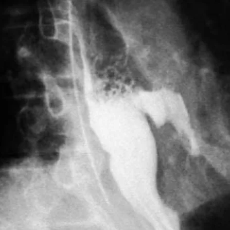 ESOPHAGEAL DIVERTICULUM - PERFORATION