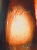 ESOPGAGEAL FIBROMA