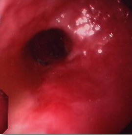ESOPHAGEAL STENOSIS