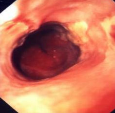 ESOPHAGEAL STENOSIS