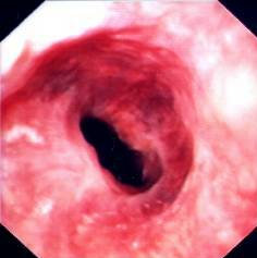 ESOPHAGEAL STENOSIS