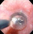 ESOPHAGEAL STRICTURE - BALOON DILATATION