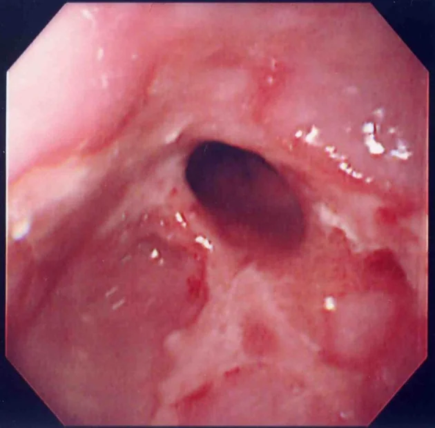 ESOPHAGEAL STRICTURE 
