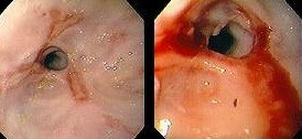 ESOPHAGEAL STRICTURE 