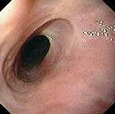 ESOPHAGEAL STRICTURE