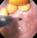 ESOPHAGEAL STRICTURE