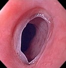 ESOPHAGEAL WEB
