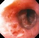 ESOPHAGITIS