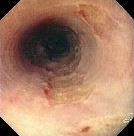 CMV ESOPHAGITIS