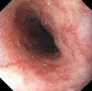 POST IRRADIATION ESOPHAGITIS