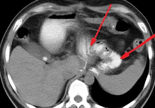 ESOPHAGO-GASTRIC JUNCTION GIST