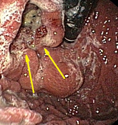 ESOPHAGO-GASTRIC JUNCTION GIST