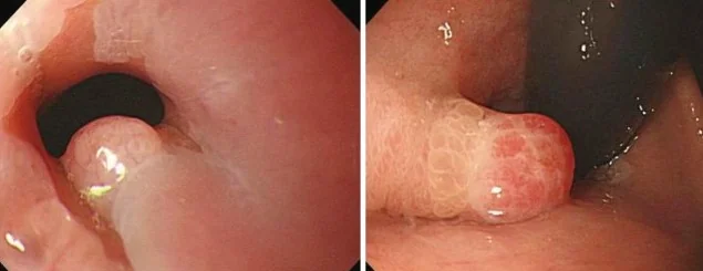 ESOPHAGO-GASTRIC JUNCTION PAPILLOMA