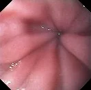 ESOPHAGEAL ACHALASIA