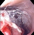 ESOPHAGUS ECTOPIC HAIR