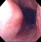 EXTRINSIC COMPRESSION OF ESOPHAGUS