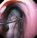 ESOPHAGUS FOREIGN BODIES