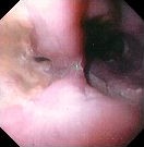 ESOPHAGEAL INTRAMURAL FISTULA