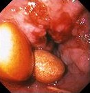ESOPHAGEAL ADENOCARCINOMA