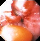 ESOPHAGEAL ADENOCARCINOMA