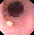 GRANULAR CELL TUMOR OF ESOPHAGUS