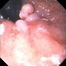 ESOPHAGEAL HYPERPLASTIC POLYP