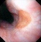 ESOPHAGEAL INLET PATCH