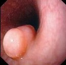 ESOPHAGEAL LEIOMYOMA