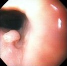 ESOPHAGEAL PAPILLOMA