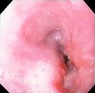 SQUAMOUS ESOPHAGEAL CARCINOMA