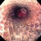ESOPHAGEAL STENT